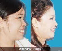 <b>35岁成年人治疗【龅牙矫正】大概需要多少钱？</b>