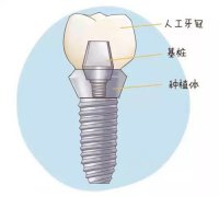 <b>做完“种植牙”的十大注意事项，你知道吗？</b>